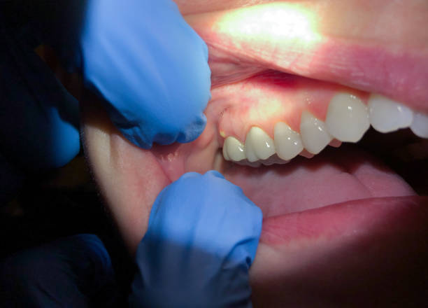 Best Chipped Tooth Repair Near Me  in Williston, ND